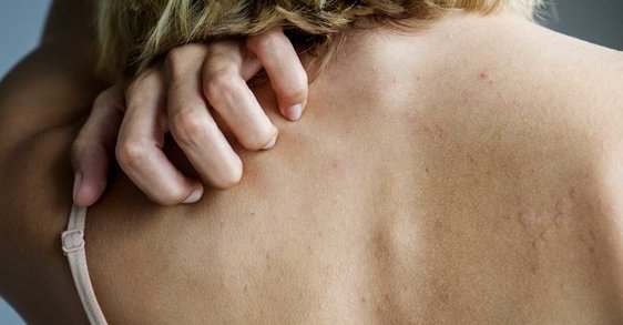 Чому під час менопаузи виникає алергія на шкірі та як її позбутися?