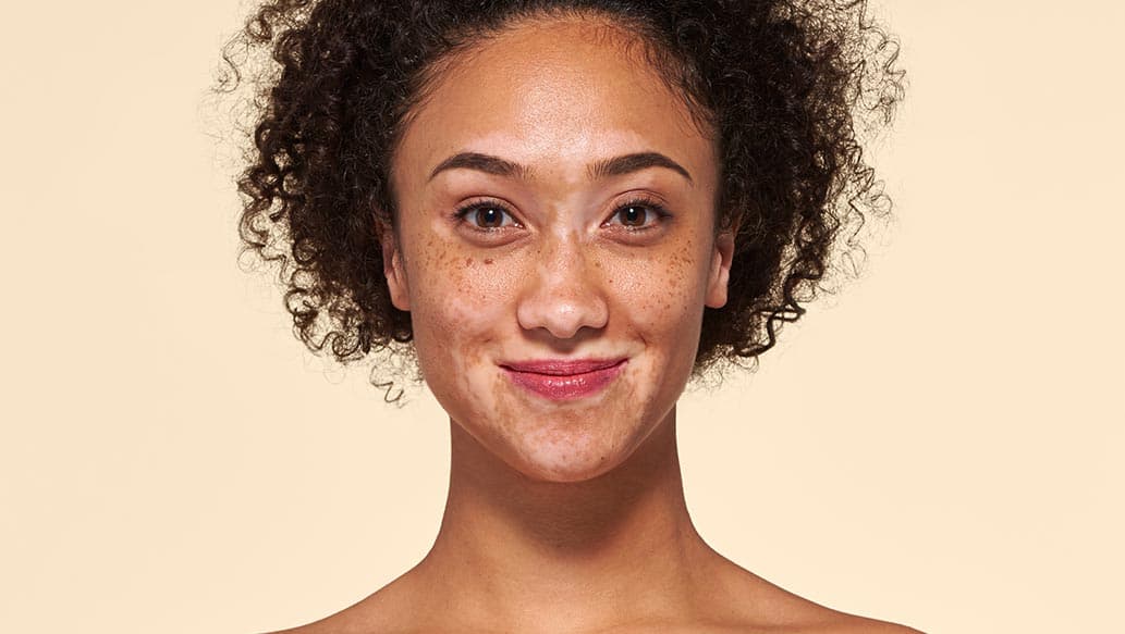 v_before-vitiligo_v2.jpg