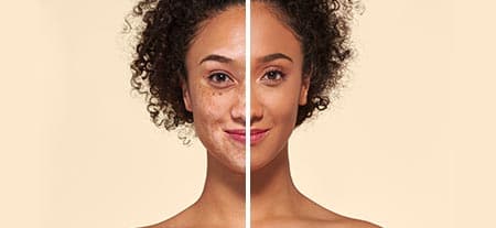 v_before_after-vitiligo_v2.jpg